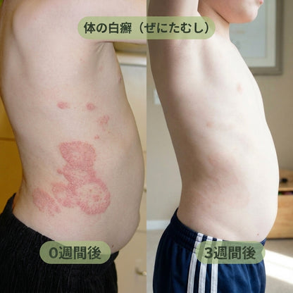 アイアンバーク＆ティーツリー 抗真菌石鹸 – 肌のカビを根元から清潔にし、バランスを整える