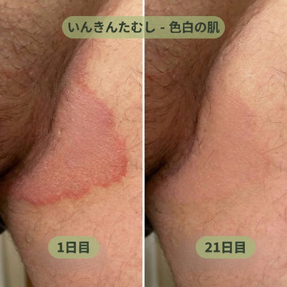 アイアンバーク＆ティーツリー 抗真菌石鹸 – 肌のカビを根元から清潔にし、バランスを整える